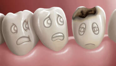 Cavity Protection