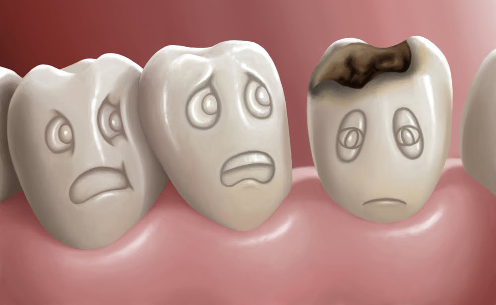 Cavity Protection