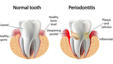 Gum Disease