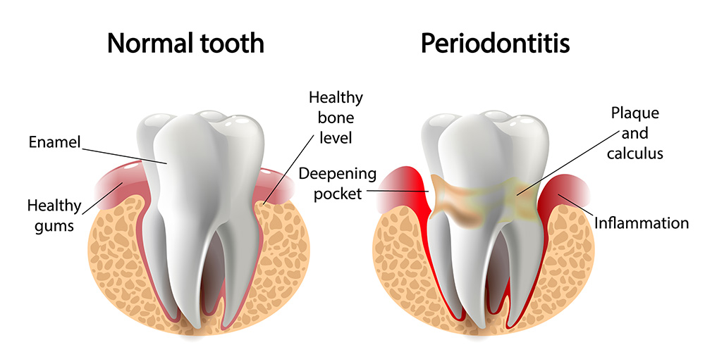 Gum Disease