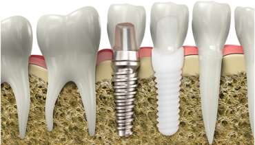 Dental Implants