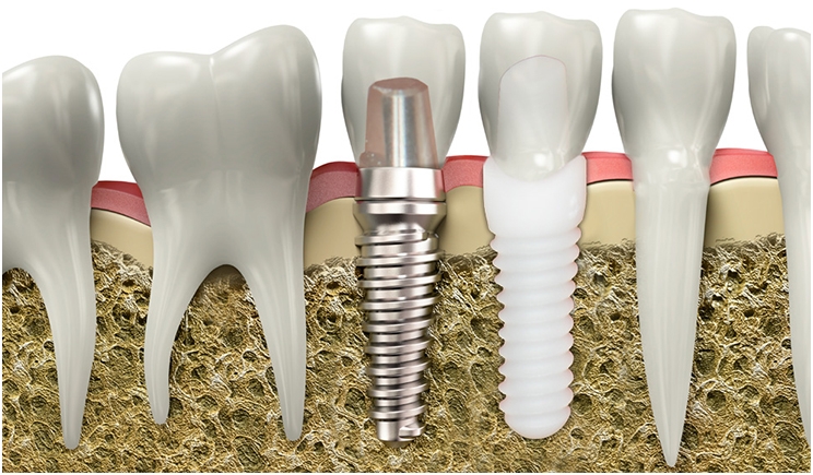 Dental Implants