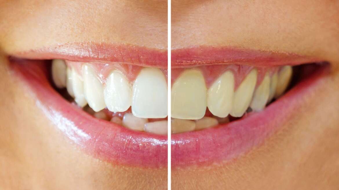 Teeth Whitening